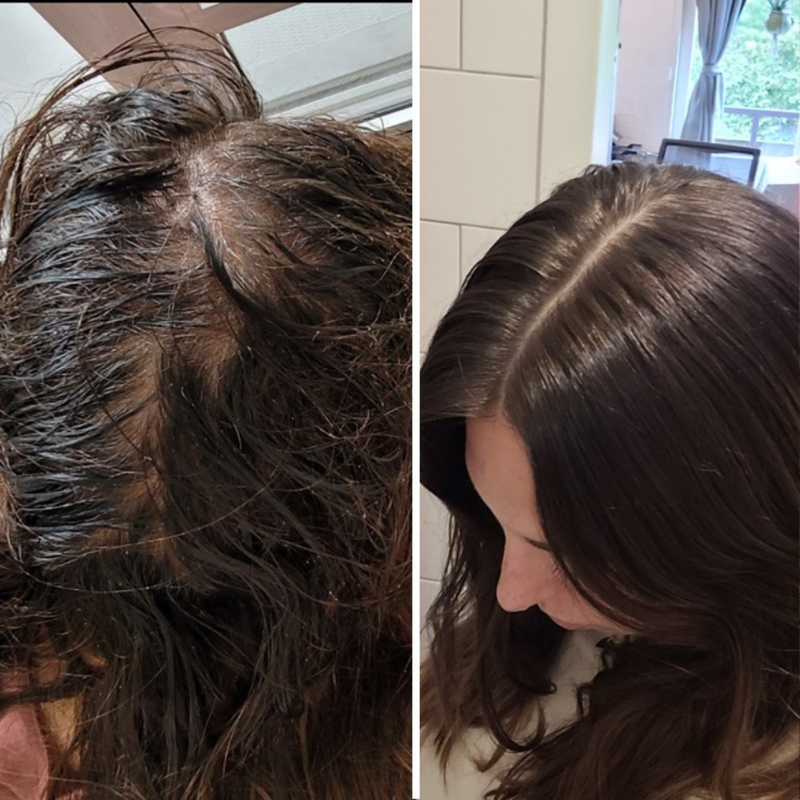 Resultaat na 5 maanden haarroos & haaruitval